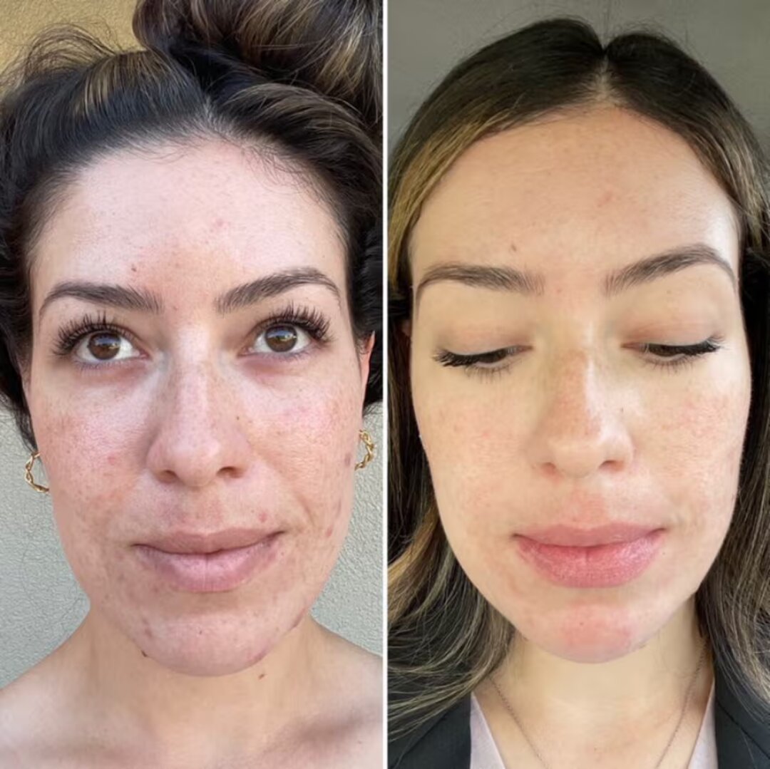 Before and after microneedling — improved tone and texture