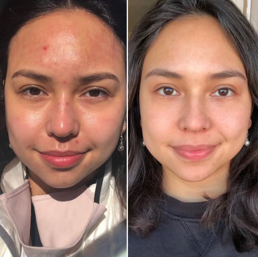 Before and after microneedling results