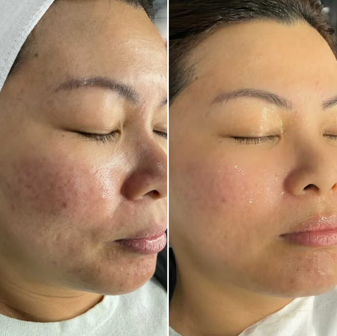 Before and after microneedling results